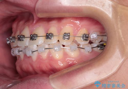 前歯のガタガタ・奥歯のかみ合わせ(シザーズバイト)を改善|1年半で完了したメタルブラケット矯正の治療中