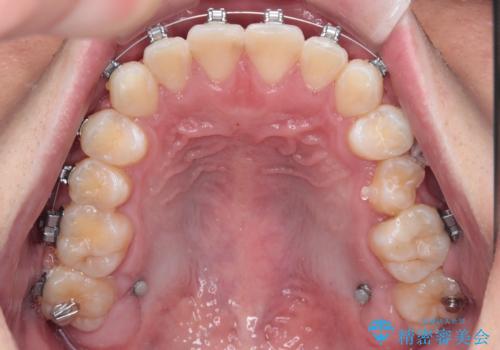 前歯のガタガタ・奥歯のかみ合わせ(シザーズバイト)を改善|1年半で完了したメタルブラケット矯正の治療中