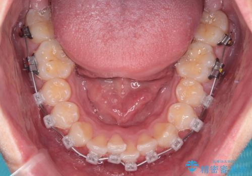 前歯のガタガタ・奥歯のかみ合わせ(シザーズバイト)を改善|1年半で完了したメタルブラケット矯正の治療中