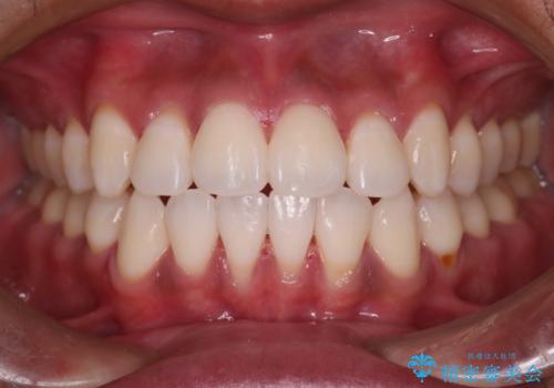 【審美装置】開口(オープンバイト)を改善の症例 治療後