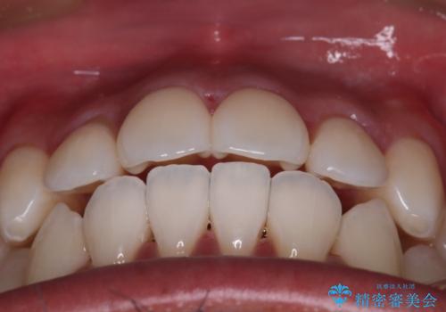【審美装置】開口(オープンバイト)を改善の治療後