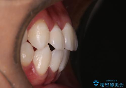 【審美装置】開口(オープンバイト)を改善の治療後