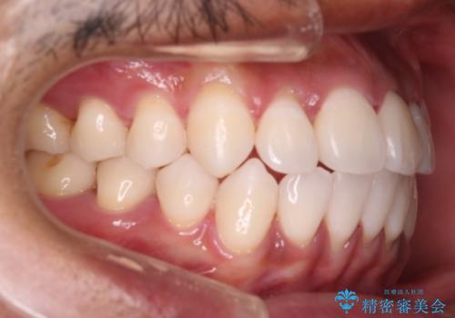 【審美装置】開口(オープンバイト)を改善の治療後