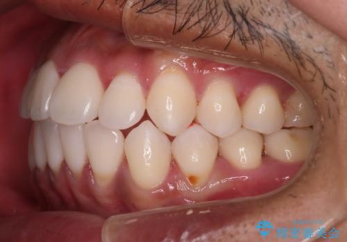 【審美装置】開口(オープンバイト)を改善の治療後