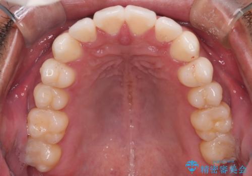 【審美装置】開口(オープンバイト)を改善の治療後