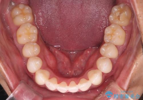 【審美装置】開口(オープンバイト)を改善の治療後