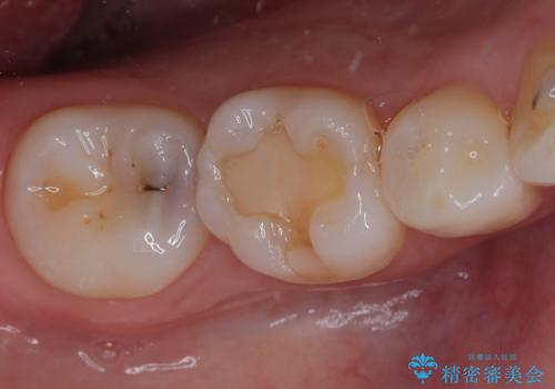 右下に虫歯ができた セラミックインレー修復の症例 治療前