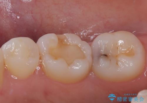 右下に虫歯ができた セラミックインレー修復の治療前