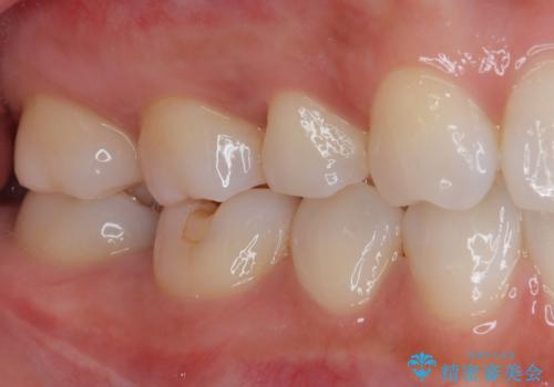右下に虫歯ができた セラミックインレー修復の治療前
