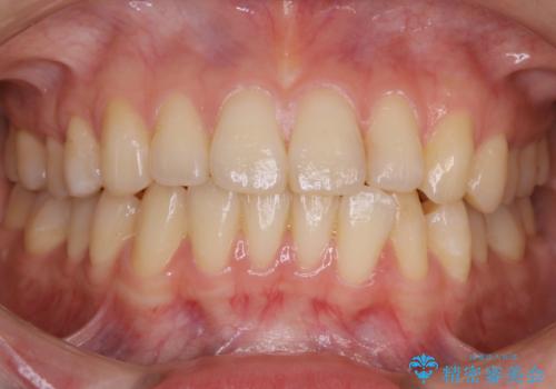 【非抜歯】インビザラインの短期治療の治療前