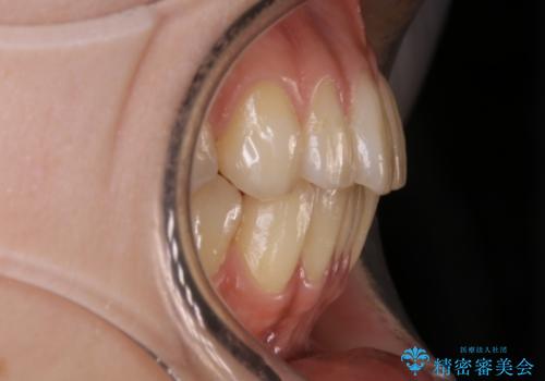 【非抜歯】インビザラインの短期治療の治療前