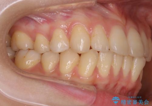 【非抜歯】インビザラインの短期治療の治療前