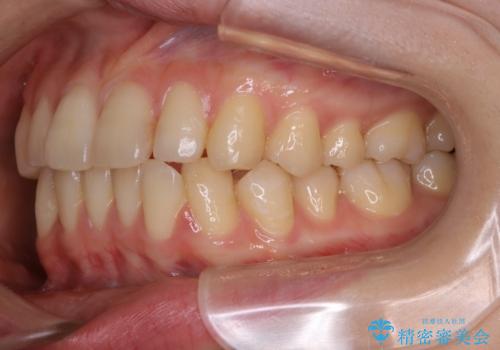 【非抜歯】インビザラインの短期治療の治療前
