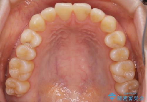 【非抜歯】インビザラインの短期治療の治療前