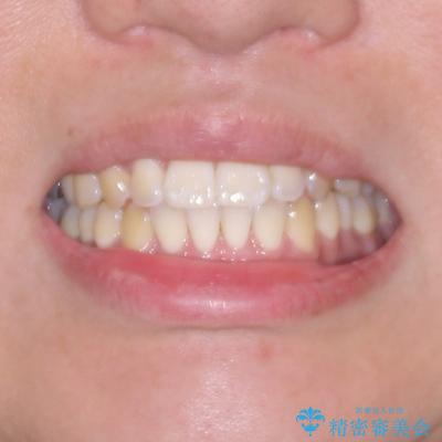 前歯のデコボコをささっと治す 短期間でのインビザライン矯正治療の治療後(顔貌)
