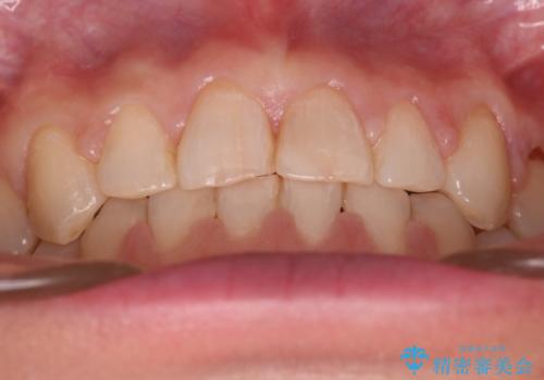 【審美装置】すきっ歯をワイヤー装置で治したいの治療後