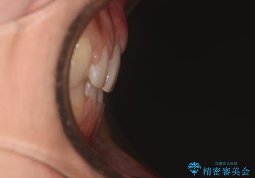 【審美装置】すきっ歯をワイヤー装置で治したいの治療後