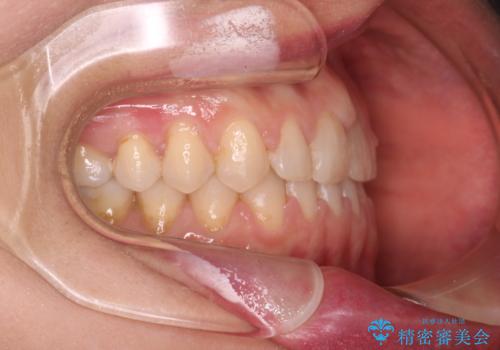 【審美装置】すきっ歯をワイヤー装置で治したいの治療後