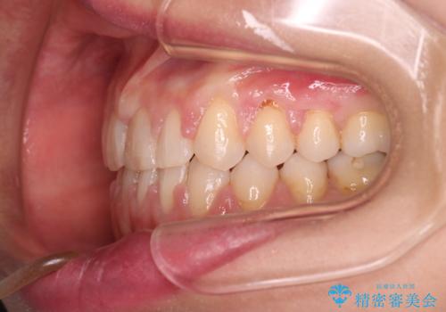 【審美装置】すきっ歯をワイヤー装置で治したいの治療後