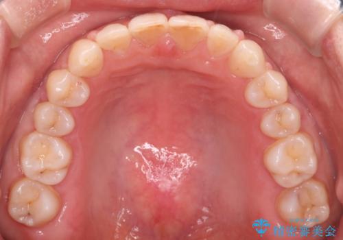 【審美装置】すきっ歯をワイヤー装置で治したいの治療後