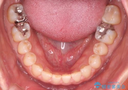 【審美装置】すきっ歯をワイヤー装置で治したいの治療後