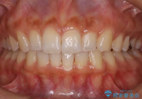 【非抜歯】ゴムかけで噛み合わせを改善!インビザライン治療の治療後