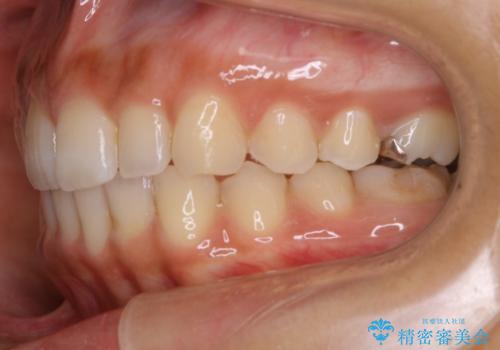 【非抜歯】ゴムかけで噛み合わせを改善!インビザライン治療の治療後