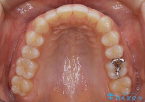 【非抜歯】ゴムかけで噛み合わせを改善!インビザライン治療の治療後