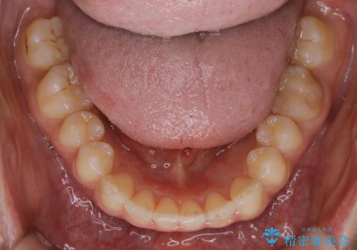 【非抜歯】ゴムかけで噛み合わせを改善!インビザライン治療の治療後