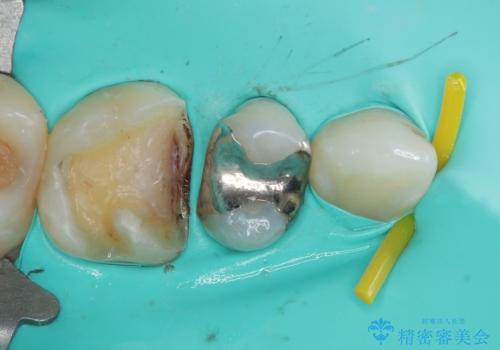 銀歯をやり替えたい セラミックインレー修復の治療中