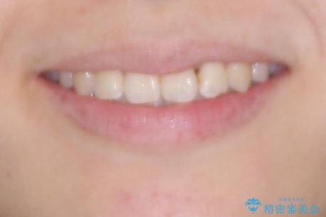 前歯のねじれ・ガタガタを10か月で改善!20代女性の矯正治療|クリアブラケットでむし歯になりにくい歯並びへ改善の治療後(顔貌)