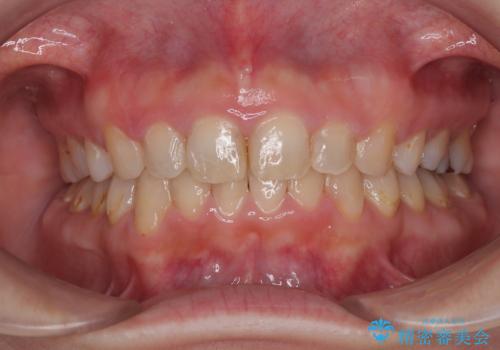 出っ歯を治したい ワイヤー装置での抜歯矯正の症例 治療後