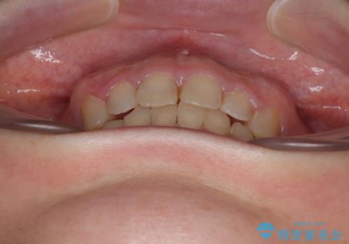 出っ歯を治したい ワイヤー装置での抜歯矯正の治療後