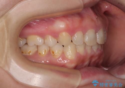出っ歯を治したい ワイヤー装置での抜歯矯正の治療後