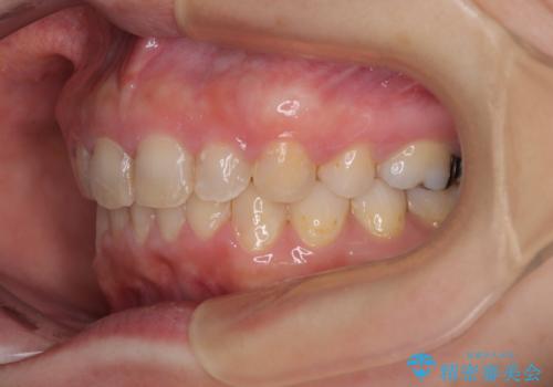 出っ歯を治したい ワイヤー装置での抜歯矯正の治療後