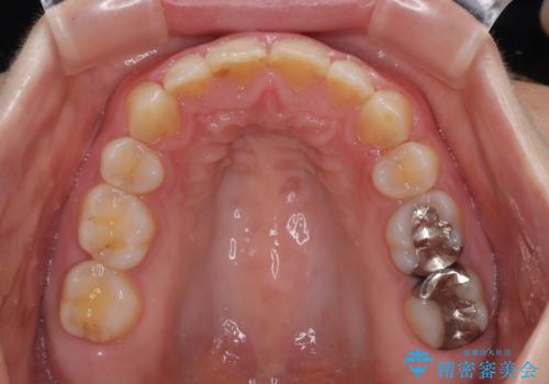 出っ歯を治したい ワイヤー装置での抜歯矯正の治療後