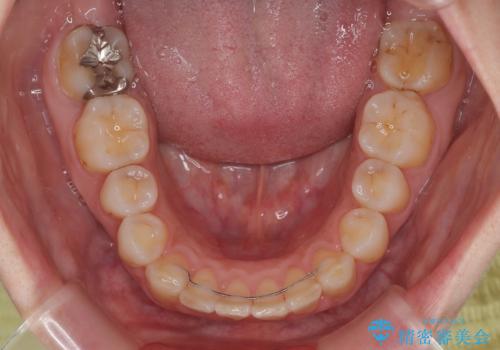 出っ歯を治したい ワイヤー装置での抜歯矯正の治療後