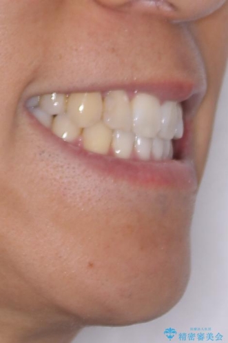 八重歯と前歯のガタガタを抜歯矯正で治療|クリアブラケット使用例の治療後(顔貌)