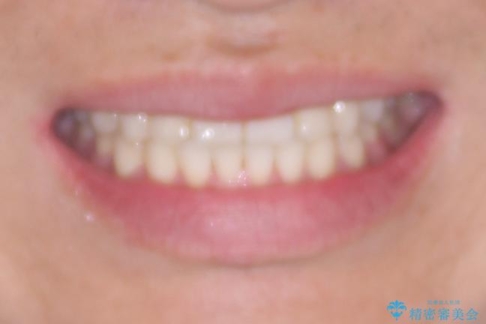 前歯のガタガタ・奥歯のかみ合わせ(シザーズバイト)を改善|1年半で完了したメタルブラケット矯正の治療後(顔貌)