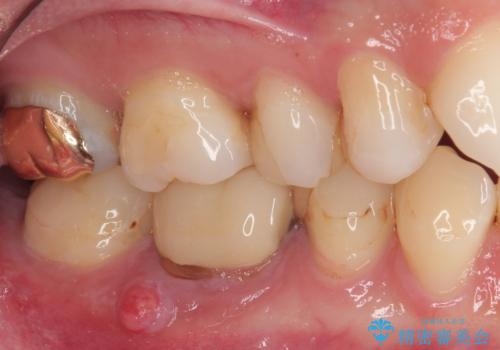 気になる奥歯のむし歯治療の治療前