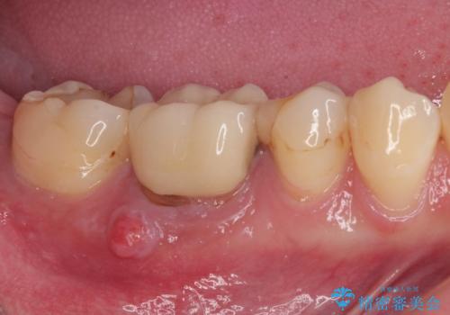 気になる奥歯のむし歯治療の症例 治療前