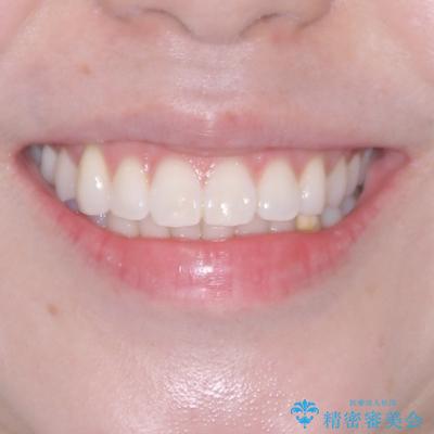 気になる前歯を短期間で治す インビザライン・モデレートでの矯正治療の治療後(顔貌)