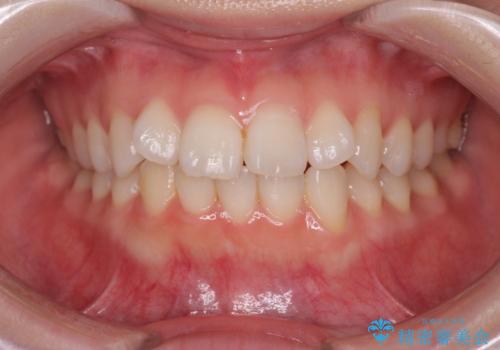 前歯のねじれをきれいに 部分ワイヤー+マウスピース矯正の症例 治療前