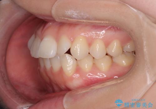 前歯のねじれをきれいに 部分ワイヤー+マウスピース矯正の治療前