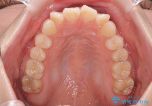 前歯のねじれをきれいに 部分ワイヤー+マウスピース矯正の治療前