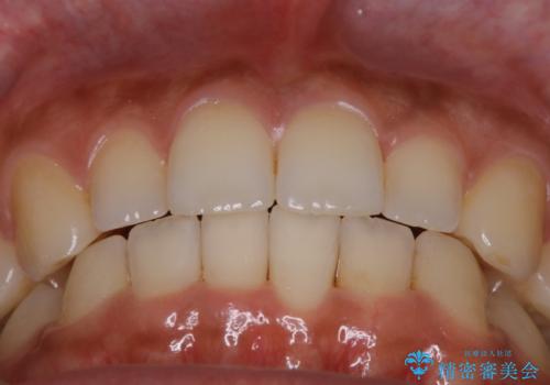 【非抜歯】ゴムかけで噛み合わせを改善!インビザライン治療の治療後