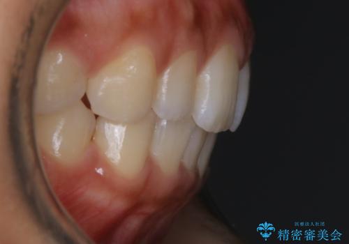 【非抜歯】ゴムかけで噛み合わせを改善!インビザライン治療の治療後