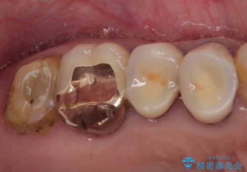 食事が取れないほどの激痛 奥歯のインプラント治療の症例 治療前