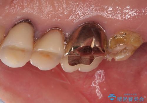 食事が取れないほどの激痛 奥歯のインプラント治療の治療前