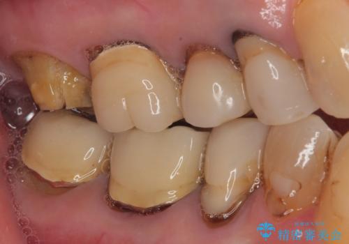 食事が取れないほどの激痛 奥歯のインプラント治療の治療前